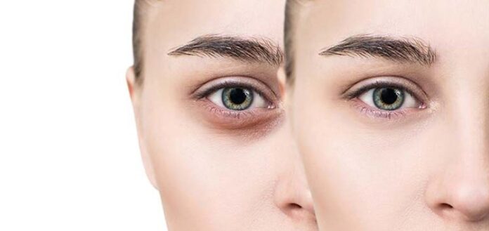 Dark Circles Under Eyes: Causes, Vitamin Deficiency, and Effective Remedies